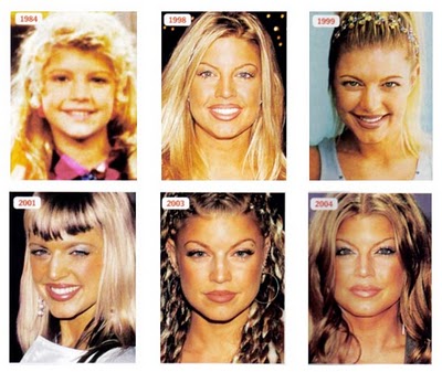 Fergie plastic surgery photos